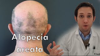 Alopecia areata: qué debes hacer