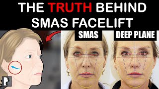Traditional Smas Facelift Explained The Truth Behind This Popular Procedure