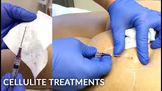 No Pain Affordable Buttock Cellulite Treatment With Subcision & Bellafill Inject