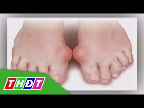 Vì sao người mắc bệnh Gout ngày càng trẻ hóa? | THDT