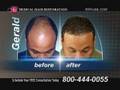  Hair Loss Treatment - Hair Transplant