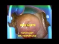 VIDEO DE CONO LEEP DR HERNANDEZ