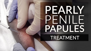 Get Rid Of Pearly Penile Papules Ppp Fordyce Spot Removal Treatment By Dr. Jason Emer Md