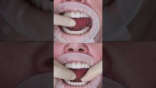 Dental Implants All On 4 In Prague