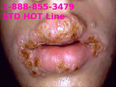 Symptoms Hiv Pictures