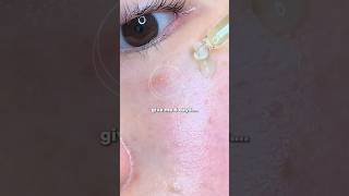 Testing Anuas Viral Azelaic Acid Serum