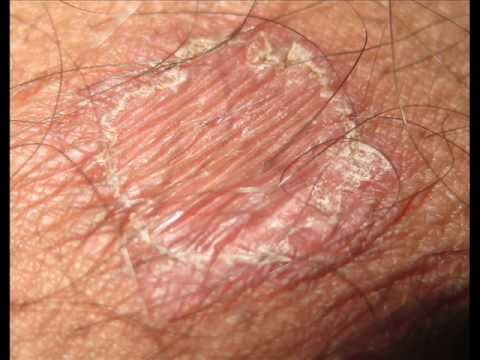 Healing Ringworm