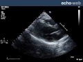 Echo-Web: Left Ventricular Aneurysm