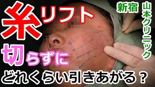 溶ける糸【3Dリフト】でたるみ解消☆山本クリニック