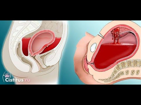 Почему После Второго Секса Идет Кровь