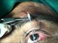 PTOSIS SURGERY VIA SUPRA-BROW SINGLE STAB INCISION-new technique frontalis sling Soosan Jacob.mpg