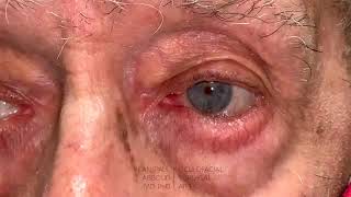 Eyelid Entropion (Before-and-After)