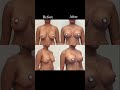 Breast Lift Revision with Implant Exchange