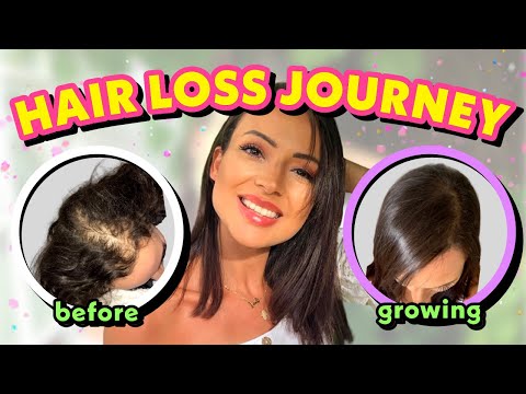HAIR LOSS TREATMENT FOR WOMEN| MY FEMALE HAIR LOSS JOURNEY + TIPS ON HAIR LOSS - YouTube