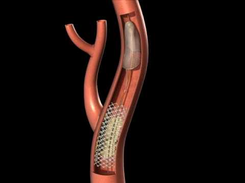 Cow Patch For Carotid Artery