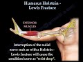 Humerus Holstein Lewis Fracture - Everything You Need To Know - Dr. Nabil Ebraheim