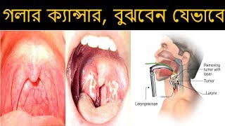 গলার ক্যান্সার, বুঝবেন যেভাবে ||Throat cancer, understand how to || Health Tips Ltd