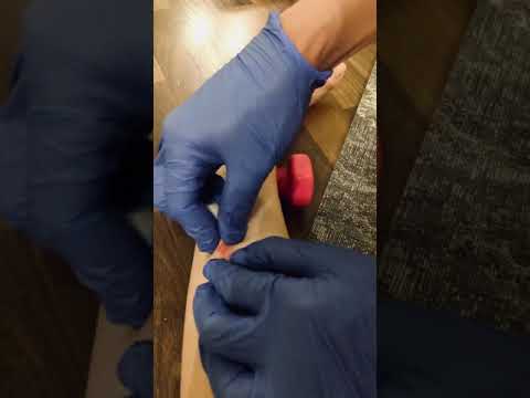 Treatment for itchy mosquito bites