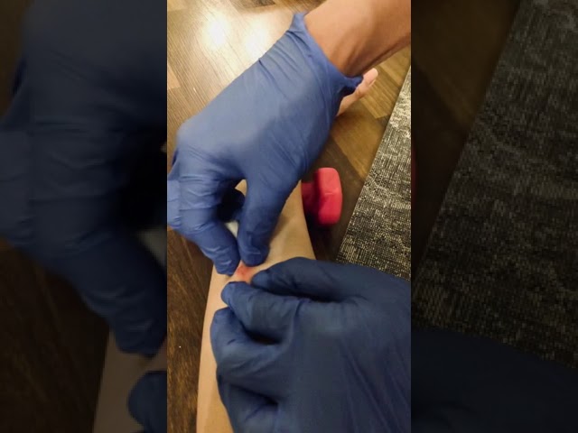 Treatment for itchy mosquito bites