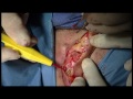 Otoplasty surgery by John E. Sherman, MD, FACS New York plastic surgeon