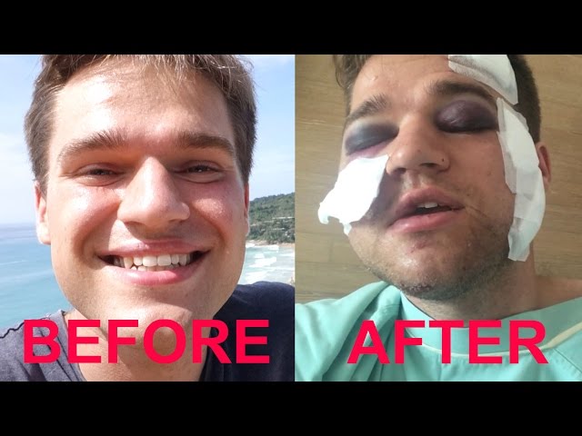 YouTuber Gets Hit By A Drunk Driver In Thailand And Vlogs About His Recovery - Video