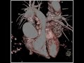 MDCT 64: Aortic Aneurysm VRT 4D (5 of 5)