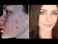 How To Cover Acne & Scars | Everyday Makeup Transformation Routine