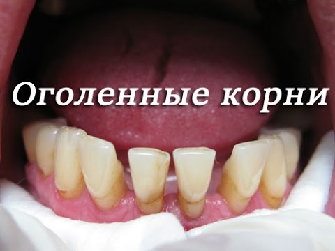 0 - Відходять десна від зубів: що робити в домашніх умовах, як лікувати