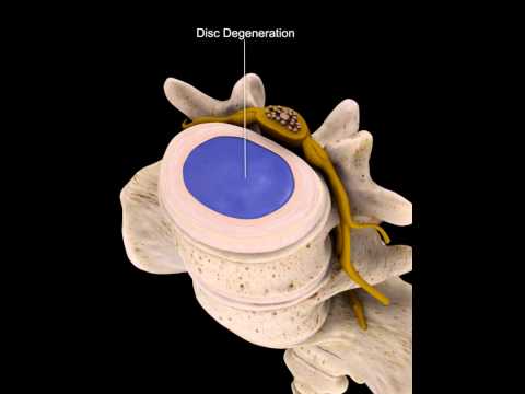 Clip 3D mô phỏng quá trình thoát vị đĩa đệm - An Cốt Nam