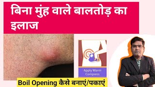 बलतड Boil क पकन क उपय बन मह वल Boil क इलज..