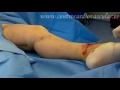 safenectomia