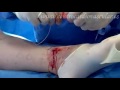 safenectomia