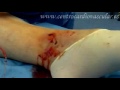 safenectomia