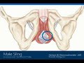 Incontinence is Treatable - Male Sling, Dr. Riemenschneider incontinence402