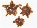 Kidney Stones Home Remedies and Cures “Kidney Stones”