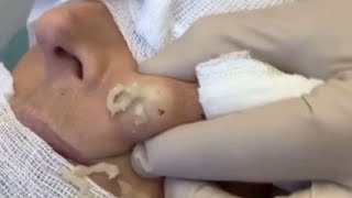 Large Blackheads Cystic Acne Blackheads&Whiteheads Removal Pimple Popping