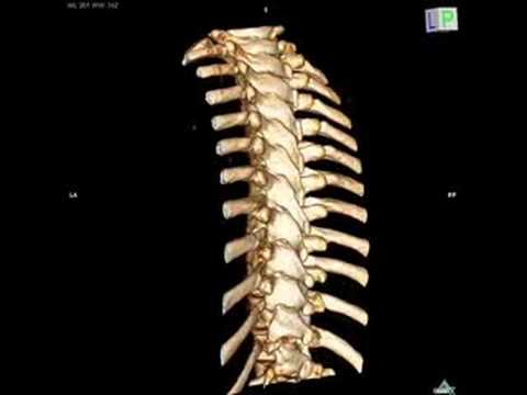 My Spine, 3D, DICOM, OsiriX