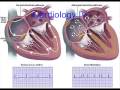 cardiac arrhythmia - origin of impulse cardiac arrhythmia - origin of impulse