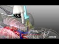 AxoTrack™ Needle Guidance Technology Demonstration - SonoSite Ultrasound