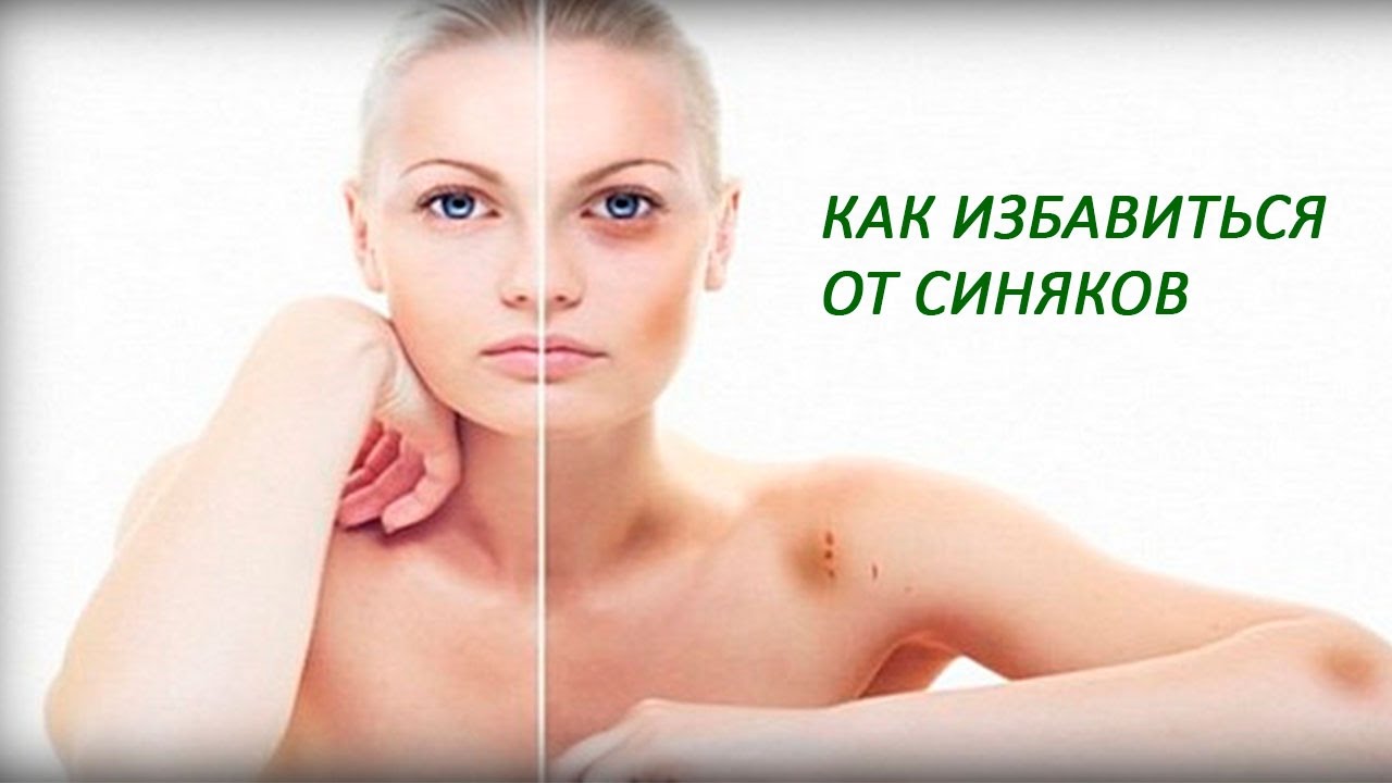 Как избавиться от синяка на лице в домашних условиях быстро за 1 день Как избавиться от синяка на лице в домашних условиях быстро за 1 день