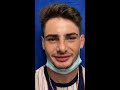 Septorhinoplasty/Sinus Surgery 3 weeks ago-doing well