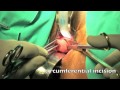 Vaginal hysterectomy for the large uterus