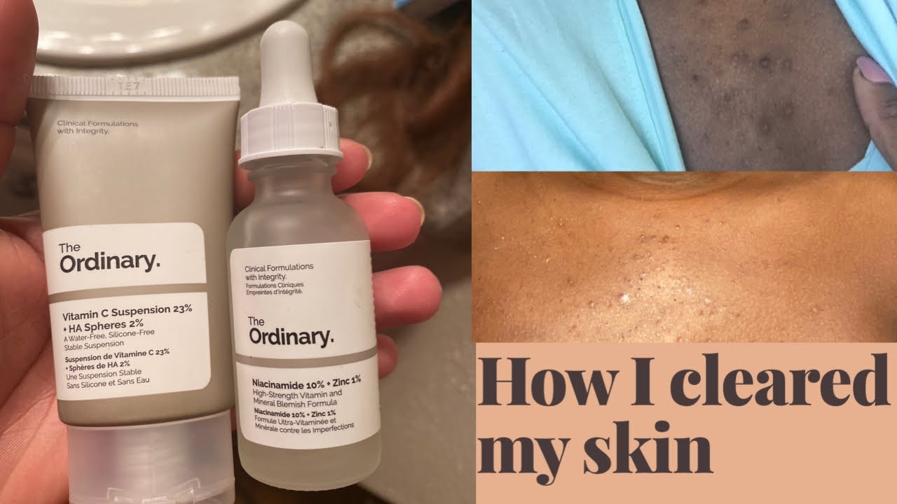 HOW I CLEARED MY SKIN WITH THE ORDINARY| ACNE + HYPERPIGMENTATION