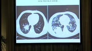Why is invasive aspergillosis such a difficult disease to diagnose and treat