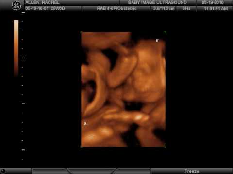 twins 4d ultrasound