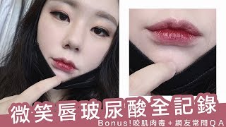 零死角美唇~微笑唇玻尿酸 咬肌肉毒全記錄 網友常見問題一次解答|AiNa 愛娜