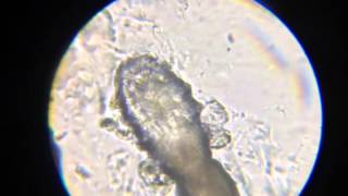 Demodex Folliculorum