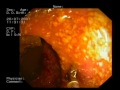 Técnicas de imagen en EII. Endoscopia en diagnóstico Crohn. Infestación por oxiuros