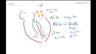 Atrial fibrillation - Dr Jamal USMLE