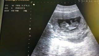 Usg Kehamilan Sendiri 12Mg Gumuss Janinnya Lompat